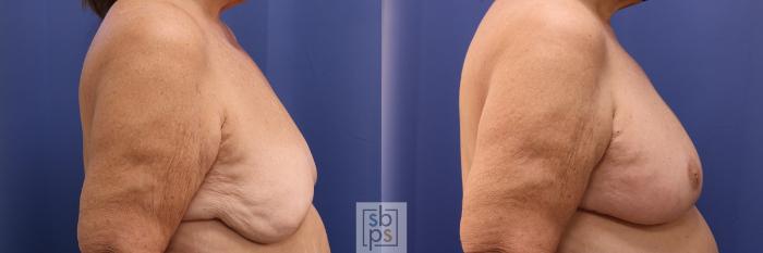 Before & After Breast Reconstruction Case 493 Right Side View in Torrance, CA
