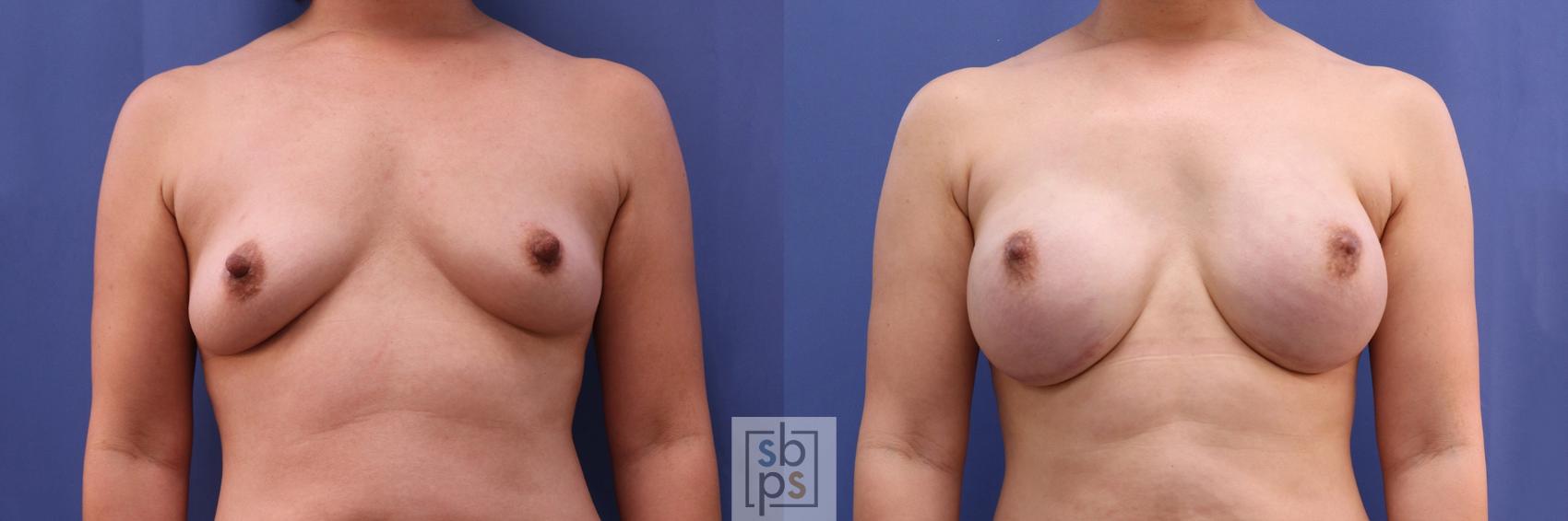 Before & After Breast Reconstruction Case 501 Front View in Torrance, CA