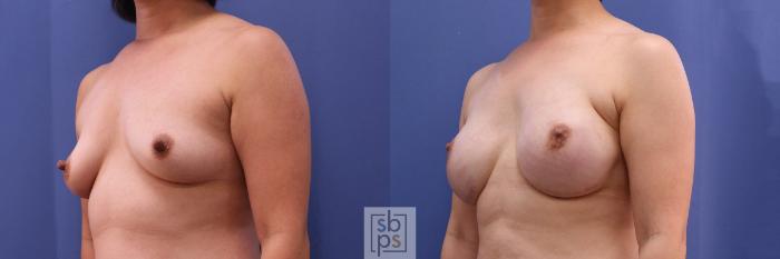 Before & After Breast Reconstruction Case 501 Left Oblique View in Torrance, CA