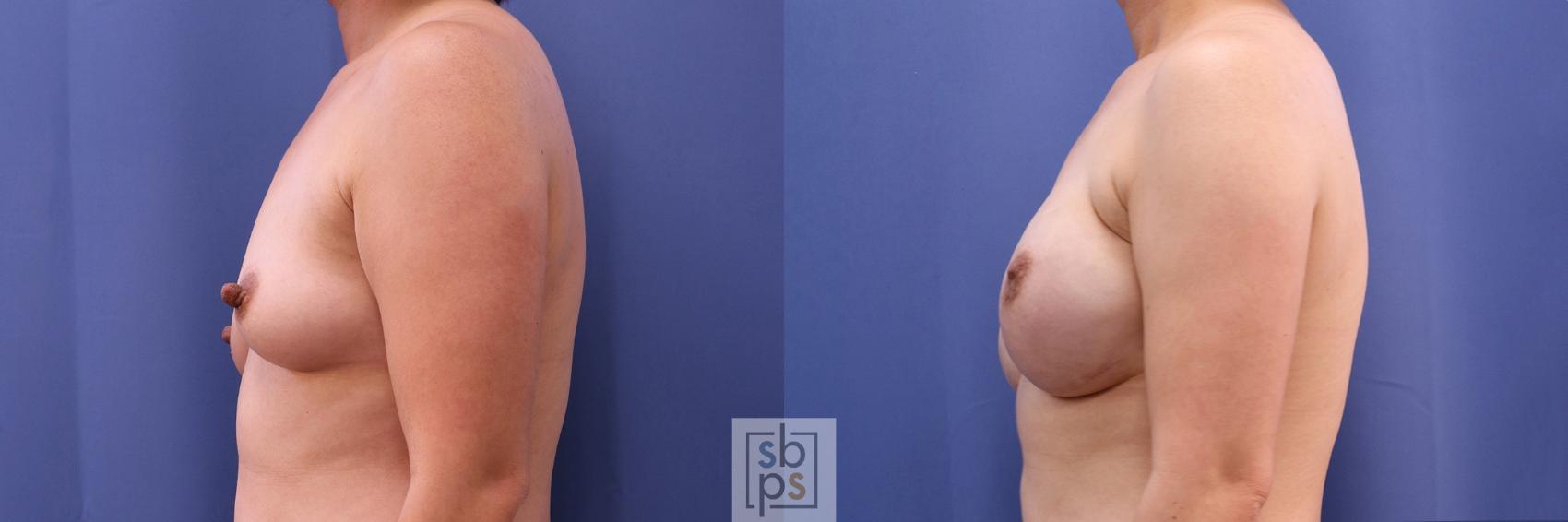 Before & After Breast Reconstruction Case 501 Left Side View in Torrance & Los Angeles, CA, CA