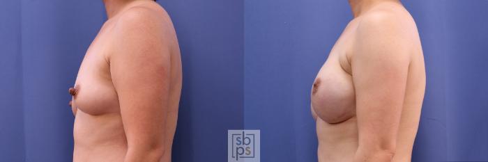 Before & After Breast Reconstruction Case 501 Left Side View in Torrance, CA