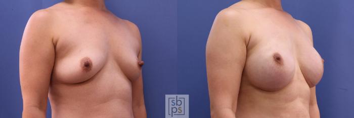 Before & After Breast Reconstruction Case 501 Right Oblique View in Torrance, CA
