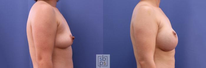 Before & After Breast Reconstruction Case 501 Right Side View in Torrance, CA