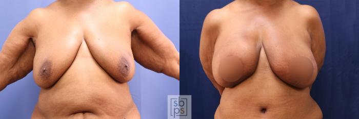 Before & After Breast Reconstruction Case 502 Front View in Torrance, CA