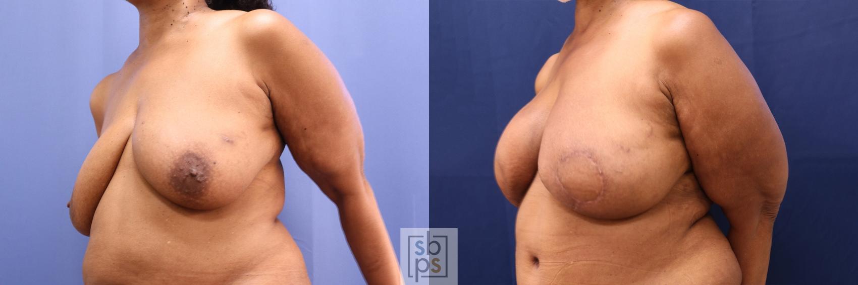 Before & After Breast Reconstruction Case 502 Left Oblique View in Torrance, CA