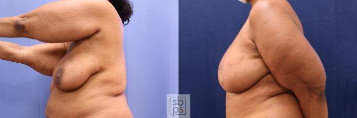 Before & After Breast Reconstruction Case 502 Left Side View in Torrance, CA