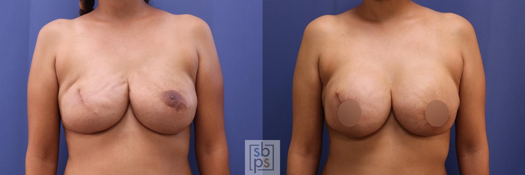 Before & After Breast Reconstruction Case 504 Front View in Torrance & Los Angeles, CA, CA