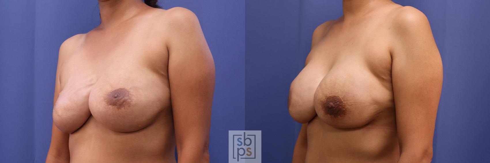 Before & After Breast Reconstruction Case 504 Left Oblique View in Torrance, CA