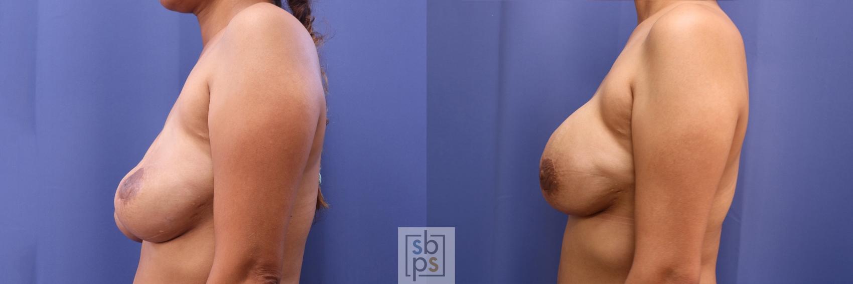 Before & After Breast Reconstruction Case 504 Left Side View in Torrance & Los Angeles, CA, CA