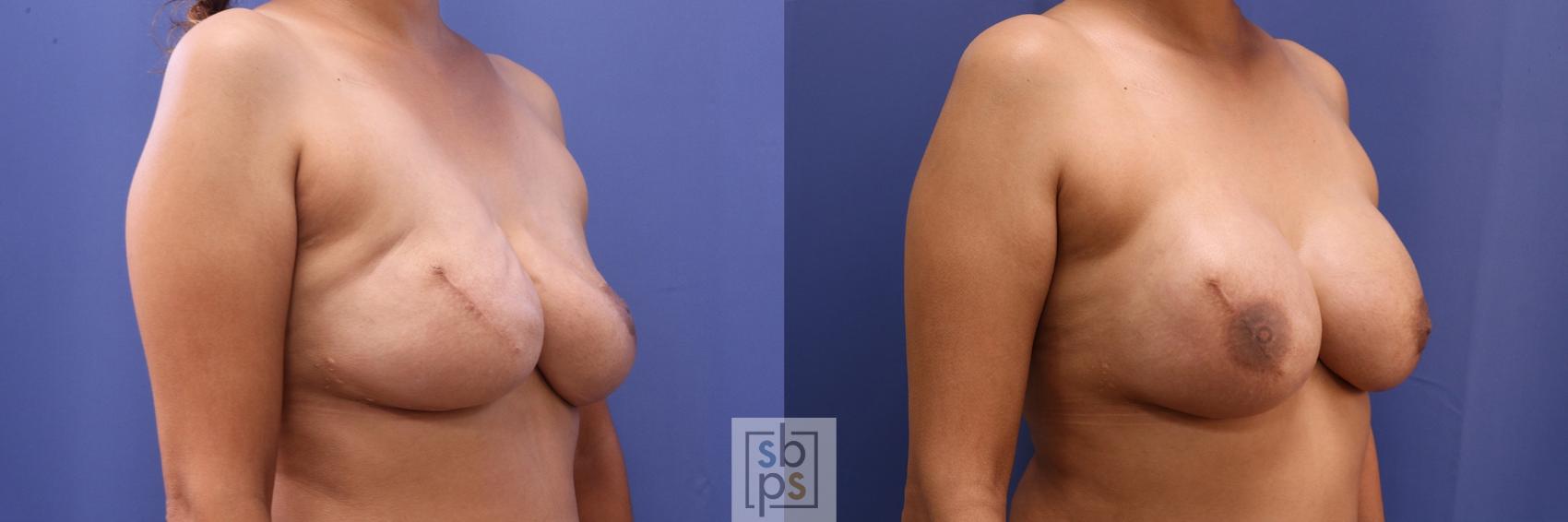 Before & After Breast Reconstruction Case 504 Right Oblique View in Torrance & Los Angeles, CA, CA