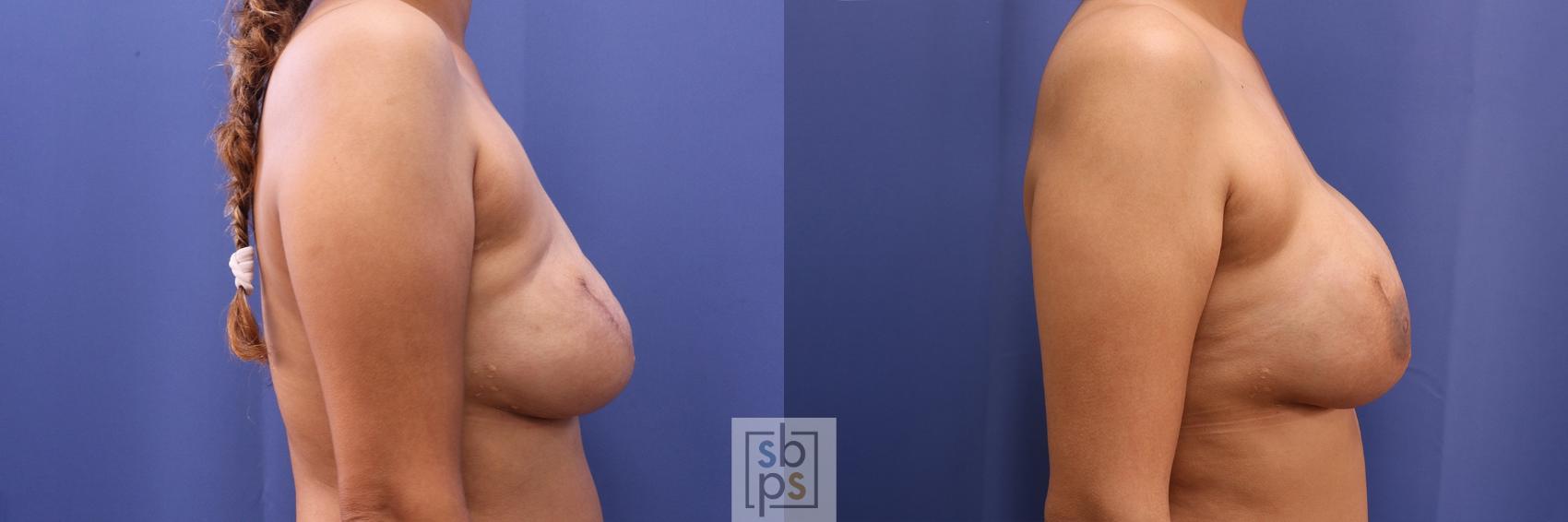 Before & After Breast Reconstruction Case 504 Right Side View in Torrance & Los Angeles, CA, CA