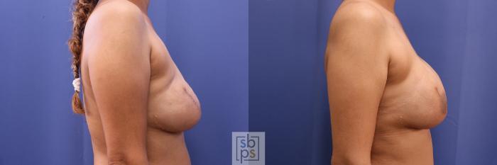 Before & After Breast Reconstruction Case 504 Right Side View in Torrance, CA