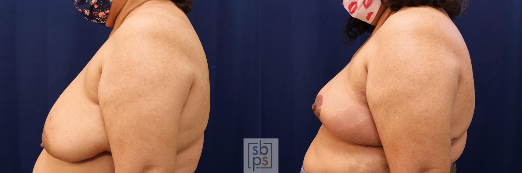 Before & After Breast Reconstruction Case 510 Left Side View in Los Angeles, Torrance & Long Beach, CA