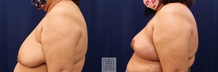 Before & After Breast Reconstruction Case 510 Left Side View in Torrance, CA