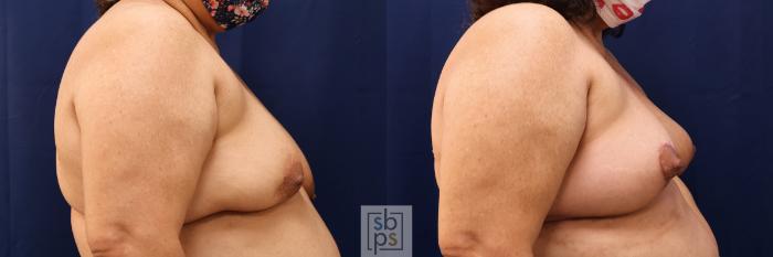 Before & After Breast Reconstruction Case 510 Right Side View in Torrance, CA