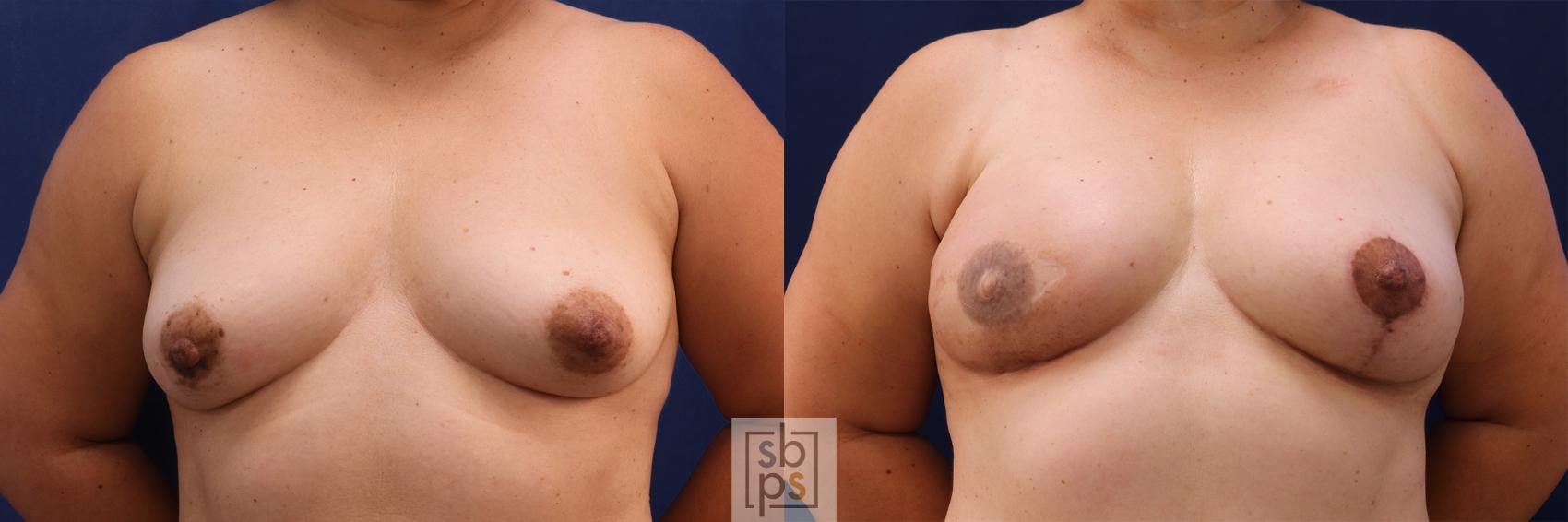 Before & After Breast Reconstruction Case 511 Front View in Torrance, CA