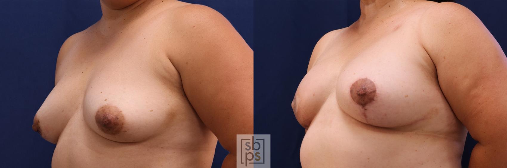 Before & After Breast Reconstruction Case 511 Left Oblique View in Torrance & Los Angeles, CA, CA