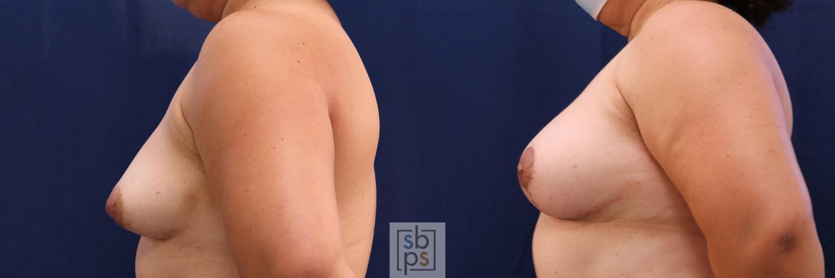 Before & After Breast Reconstruction Case 511 Left Side View in Torrance & Los Angeles, CA, CA
