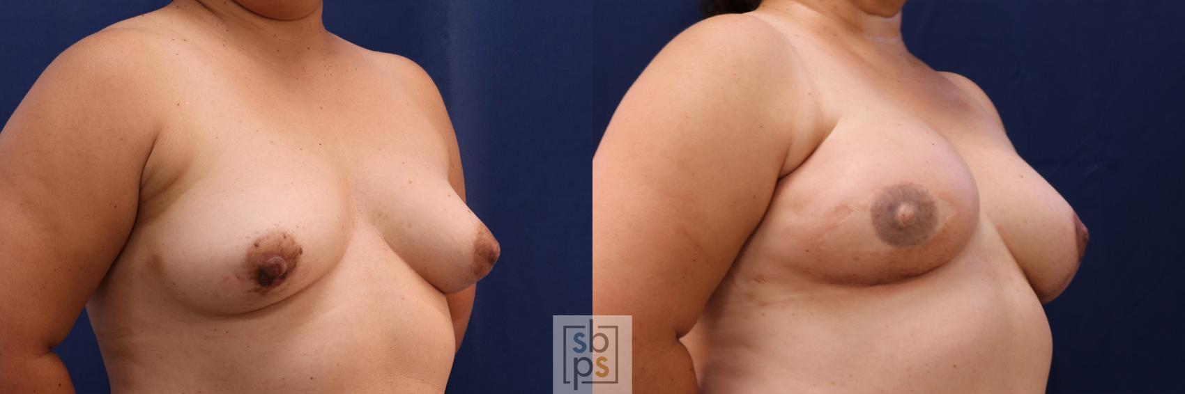Before & After Breast Reconstruction Case 511 Right Oblique View in Torrance & Los Angeles, CA, CA