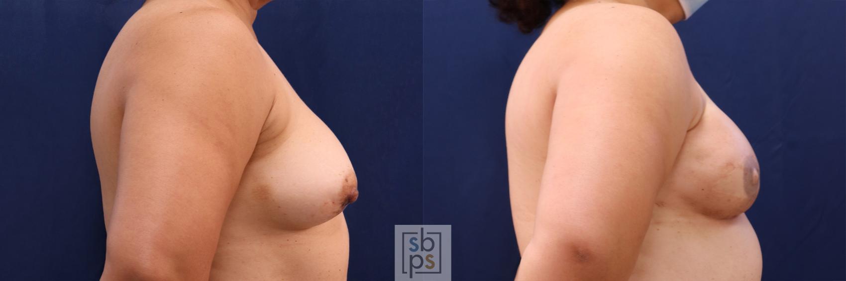 Before & After Breast Reconstruction Case 511 Right Side View in Torrance & Los Angeles, CA, CA