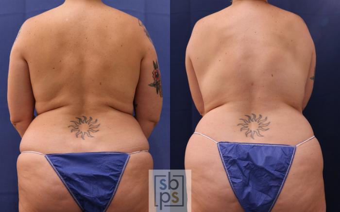 Before & After Breast Reconstruction Case 514 Back View in Torrance, CA