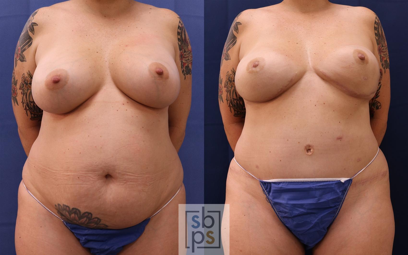 Before & After Breast Reconstruction Case 514 Front View in Torrance, CA