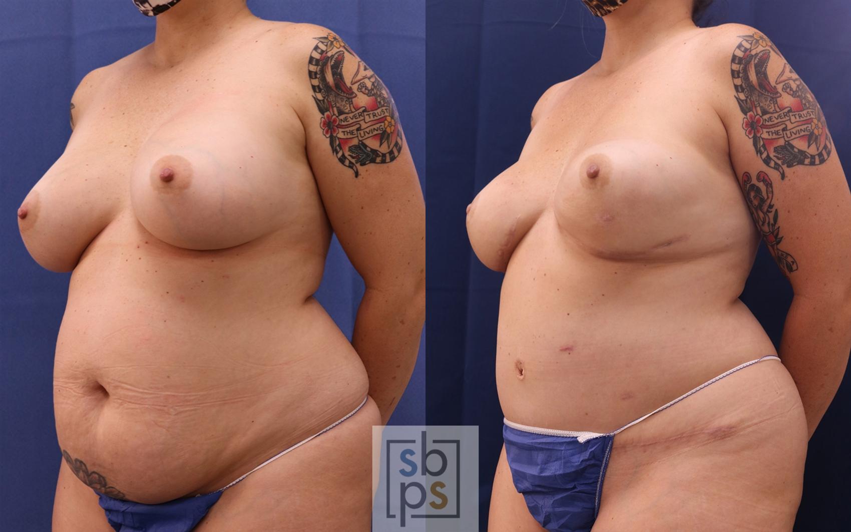 Before & After Breast Reconstruction Case 514 Left Oblique View in Torrance & Los Angeles, CA, CA