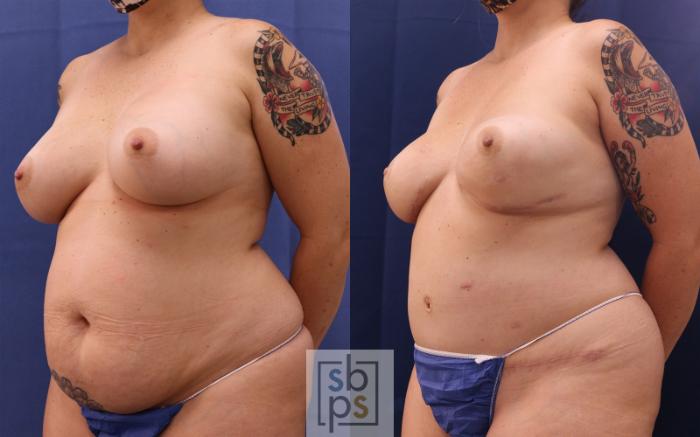 Before & After Breast Reconstruction Case 514 Left Oblique View in Torrance, CA