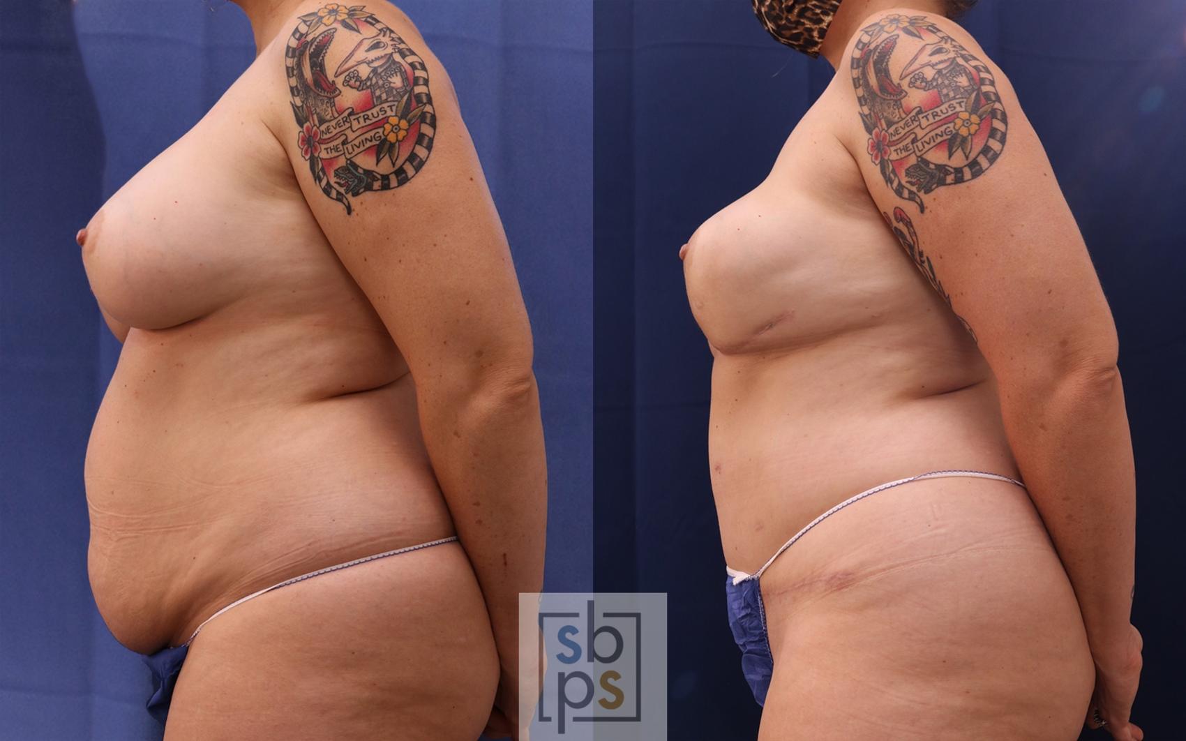 Before & After Breast Reconstruction Case 514 Left Side View in Torrance & Los Angeles, CA, CA