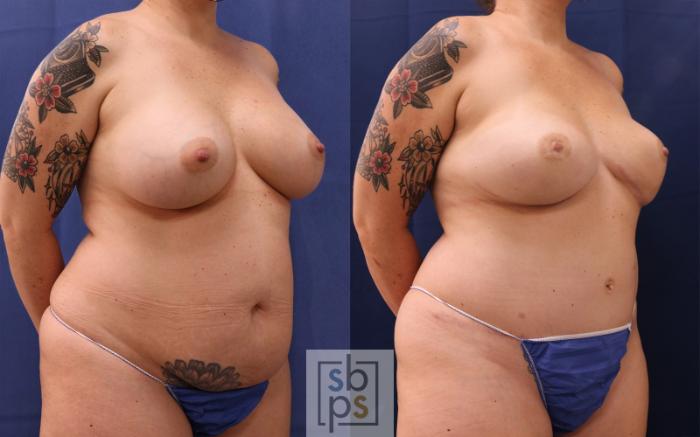 Before & After Breast Reconstruction Case 514 Right Oblique View in Torrance, CA