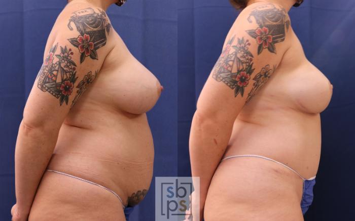 Before & After Breast Reconstruction Case 514 Right Side View in Torrance, CA