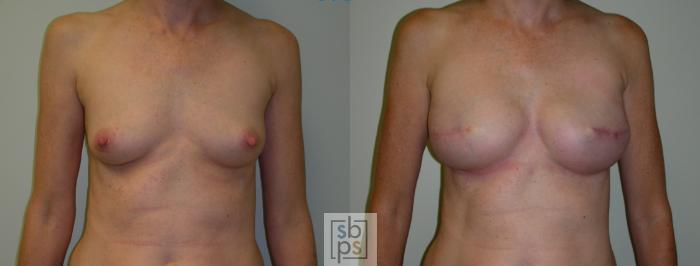 Before & After Breast Reconstruction Case 53 View #1 View in Torrance, CA