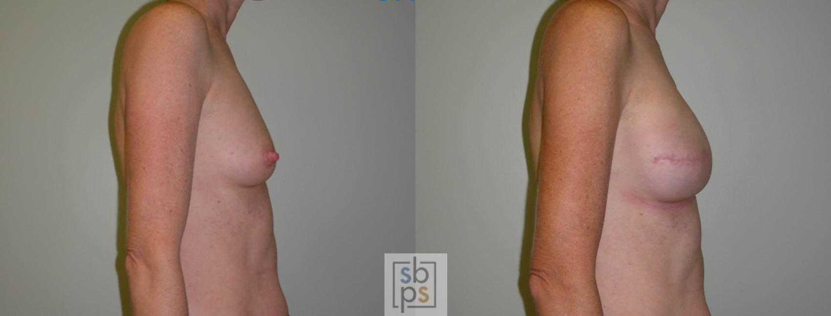 Before & After Breast Reconstruction Case 53 View #2 View in Torrance & Los Angeles, CA, CA