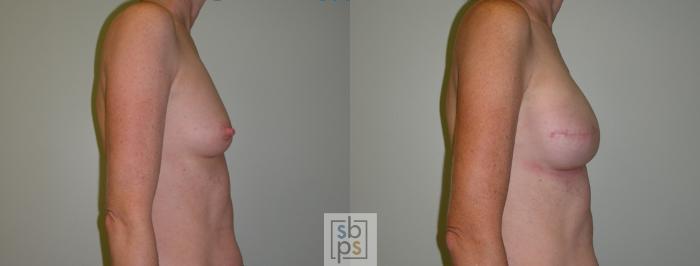 Before & After Breast Reconstruction Case 53 View #2 View in Torrance, CA