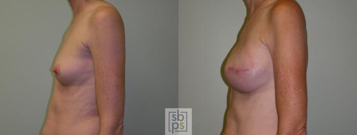 Before & After Breast Reconstruction Case 53 View #3 View in Torrance, CA