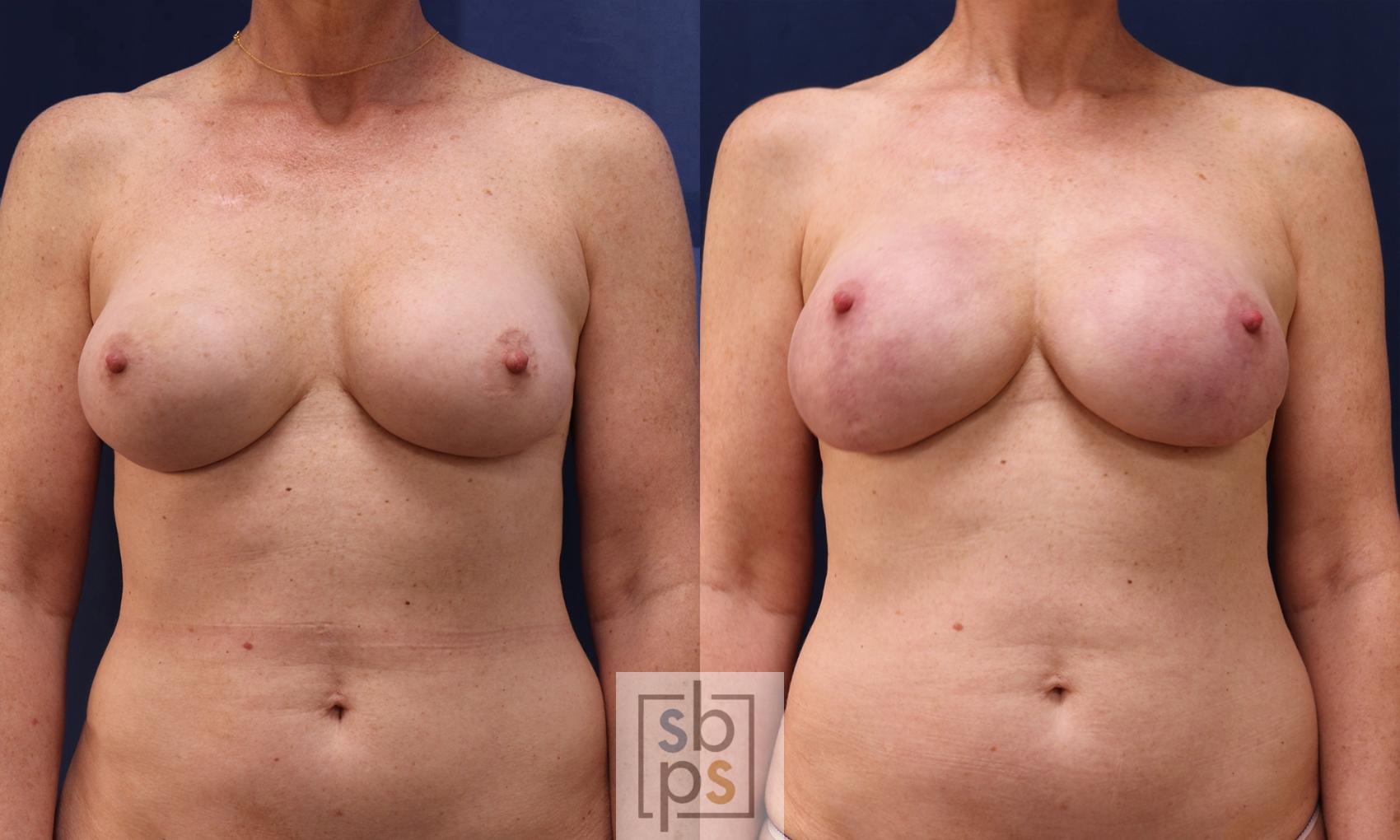 Before & After Breast Reconstruction Case 535 Front View in Torrance, CA