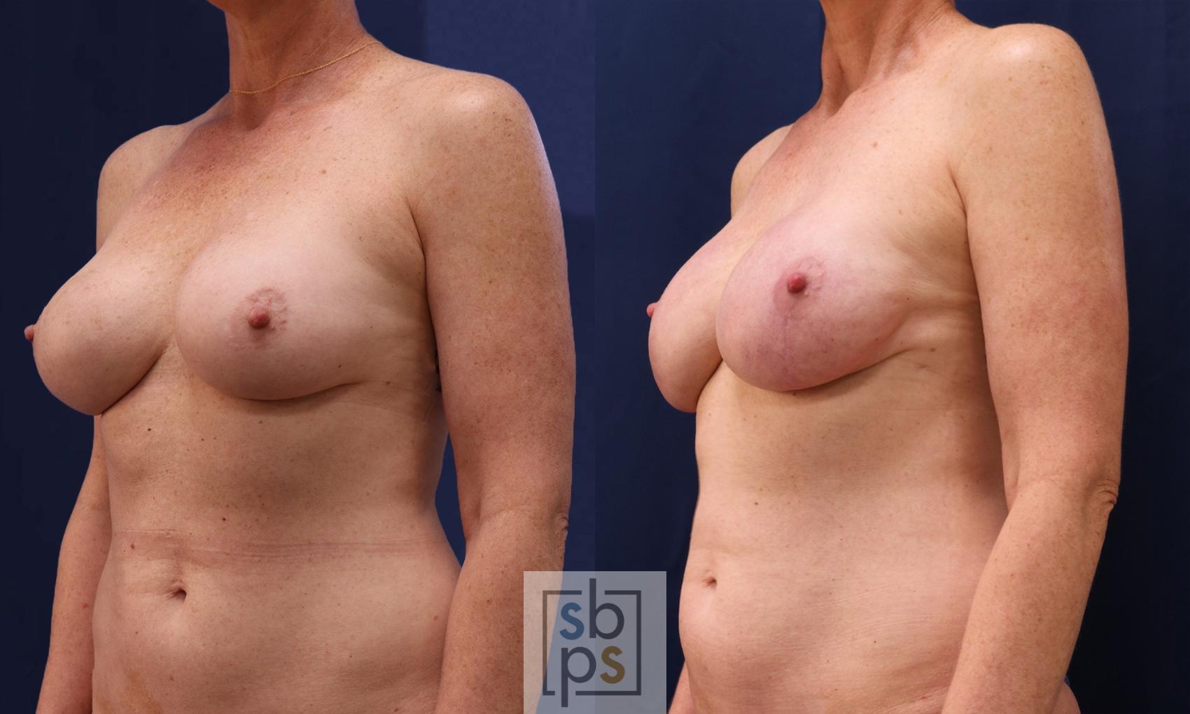 Before & After Breast Reconstruction Case 535 Left Oblique View in Torrance & Los Angeles, CA, CA