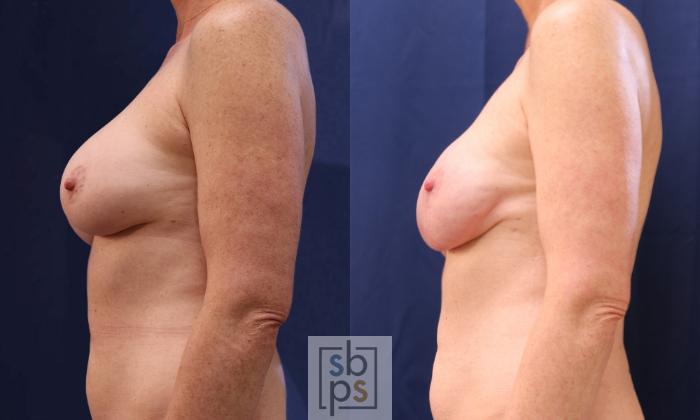 Before & After Breast Reconstruction Case 535 Left Side View in Torrance, CA