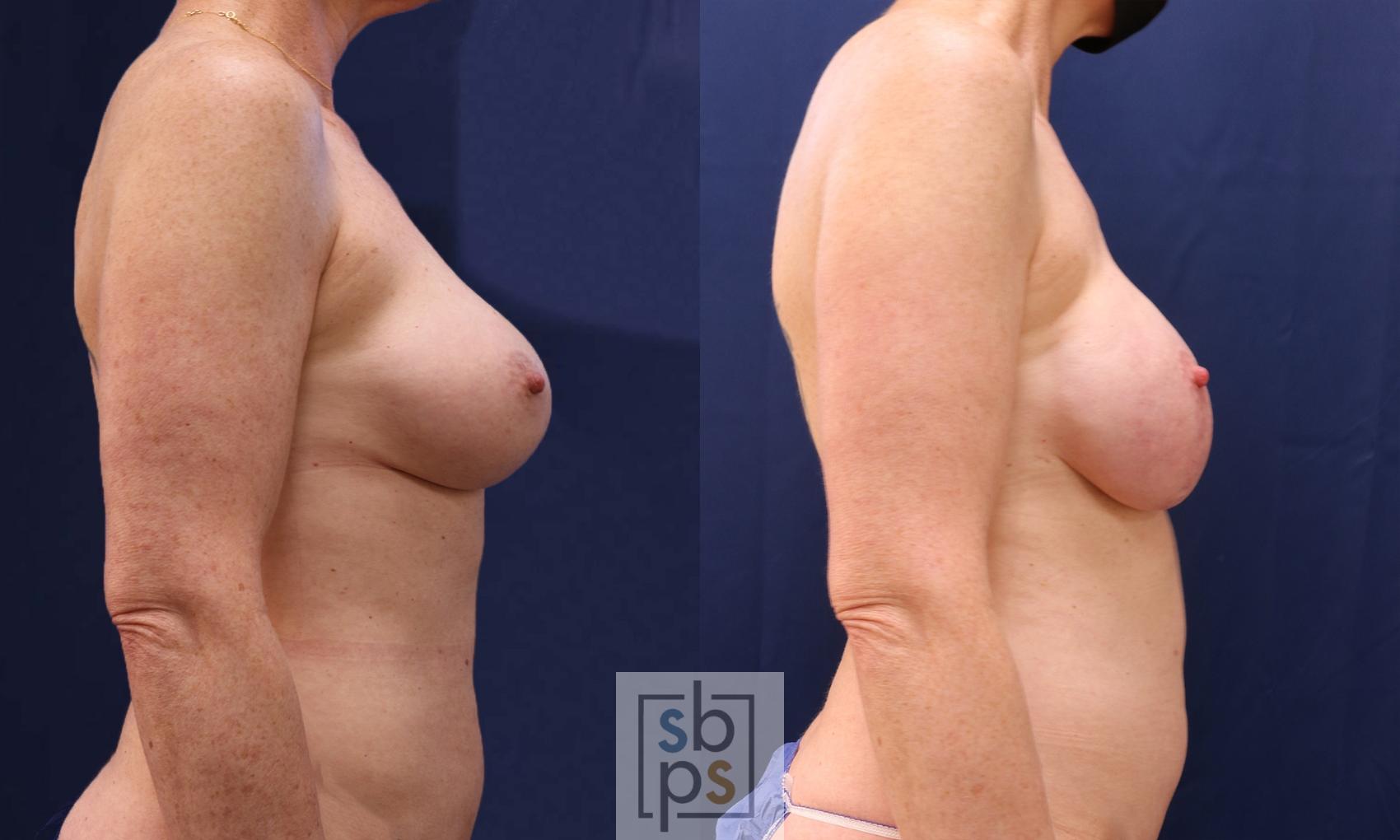 Before & After Breast Reconstruction Case 535 Right Side View in Torrance & Los Angeles, CA, CA