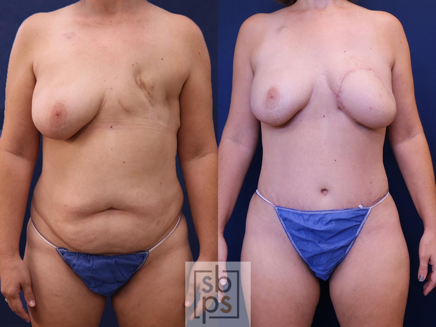 Before & After Breast Reconstruction Case 536 Front View in Torrance, CA