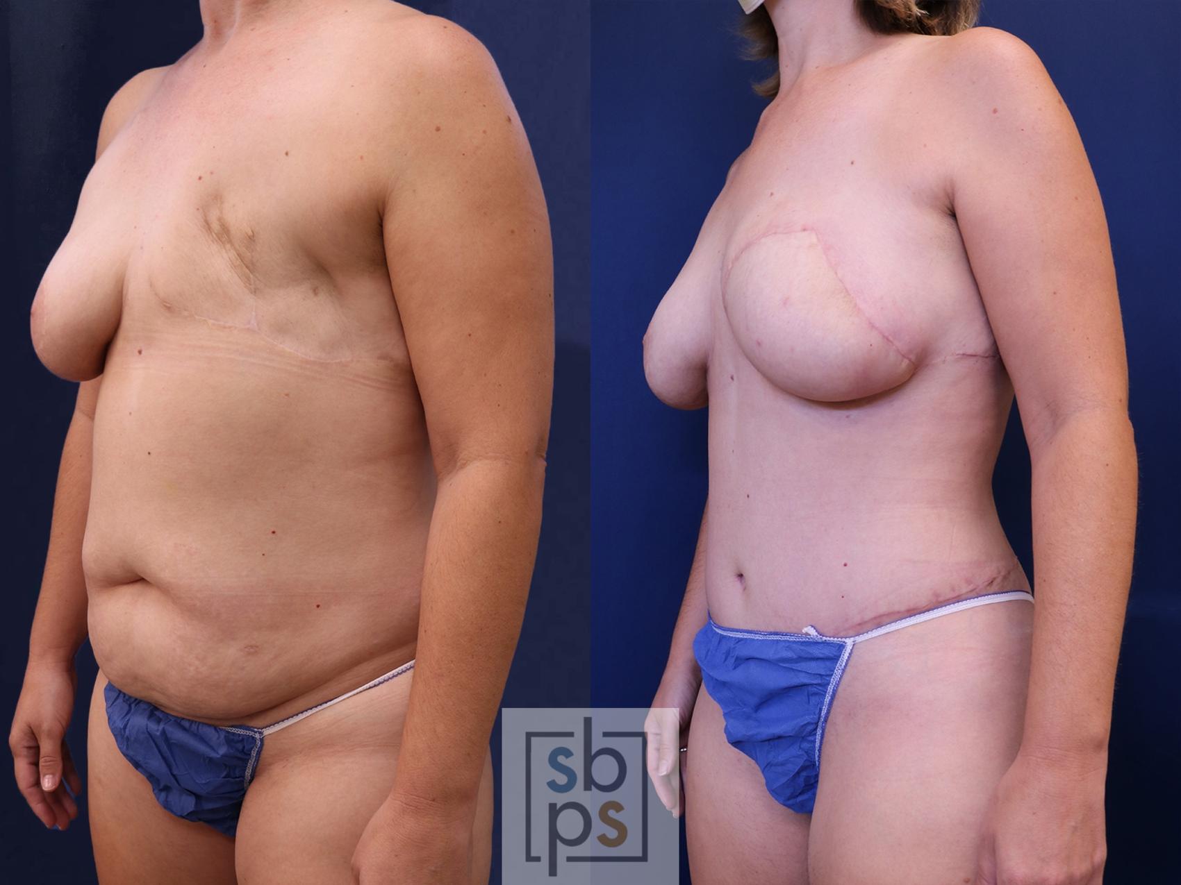 Before & After Breast Reconstruction Case 536 Left Oblique View in Los Angeles, Torrance & Long Beach, CA