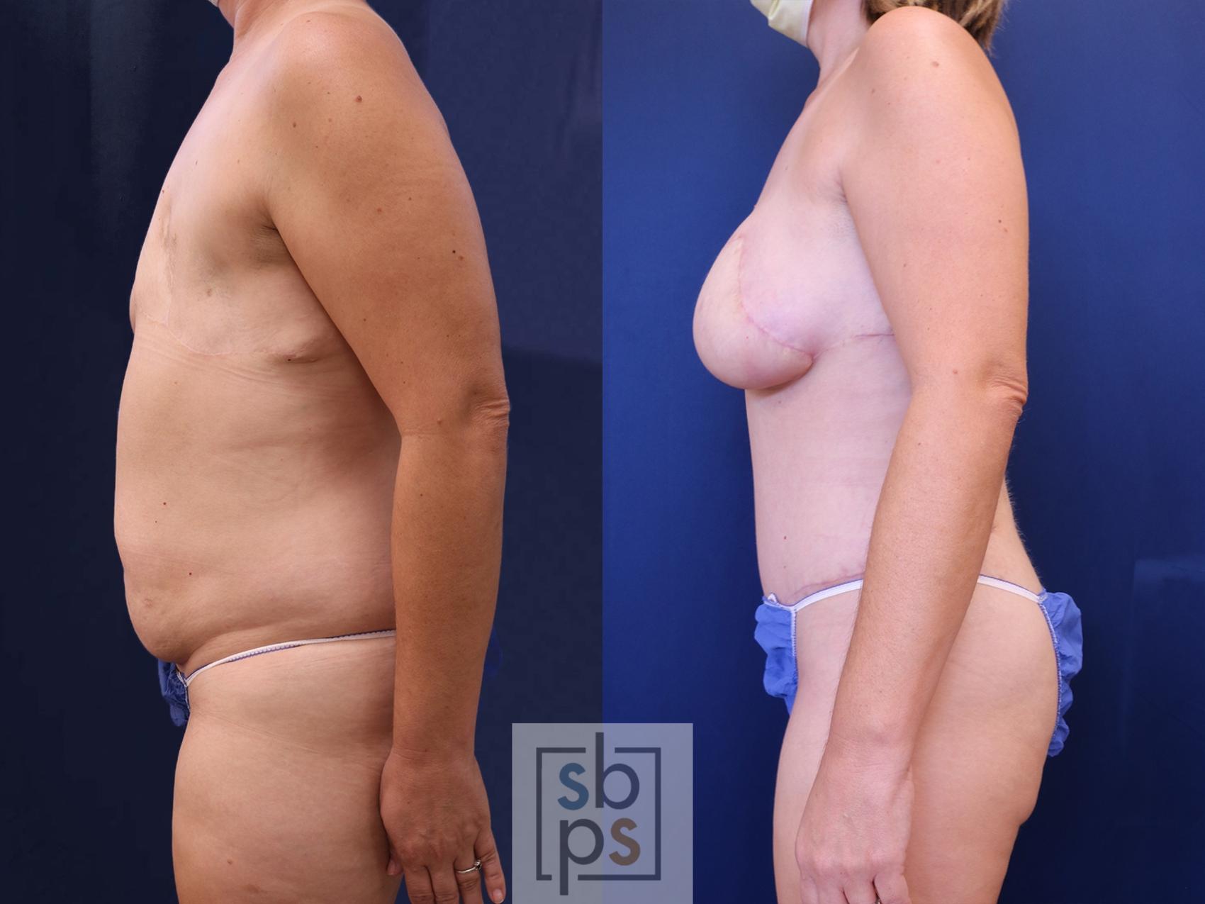 Before & After Breast Reconstruction Case 536 Left Side View in Los Angeles, Torrance & Long Beach, CA