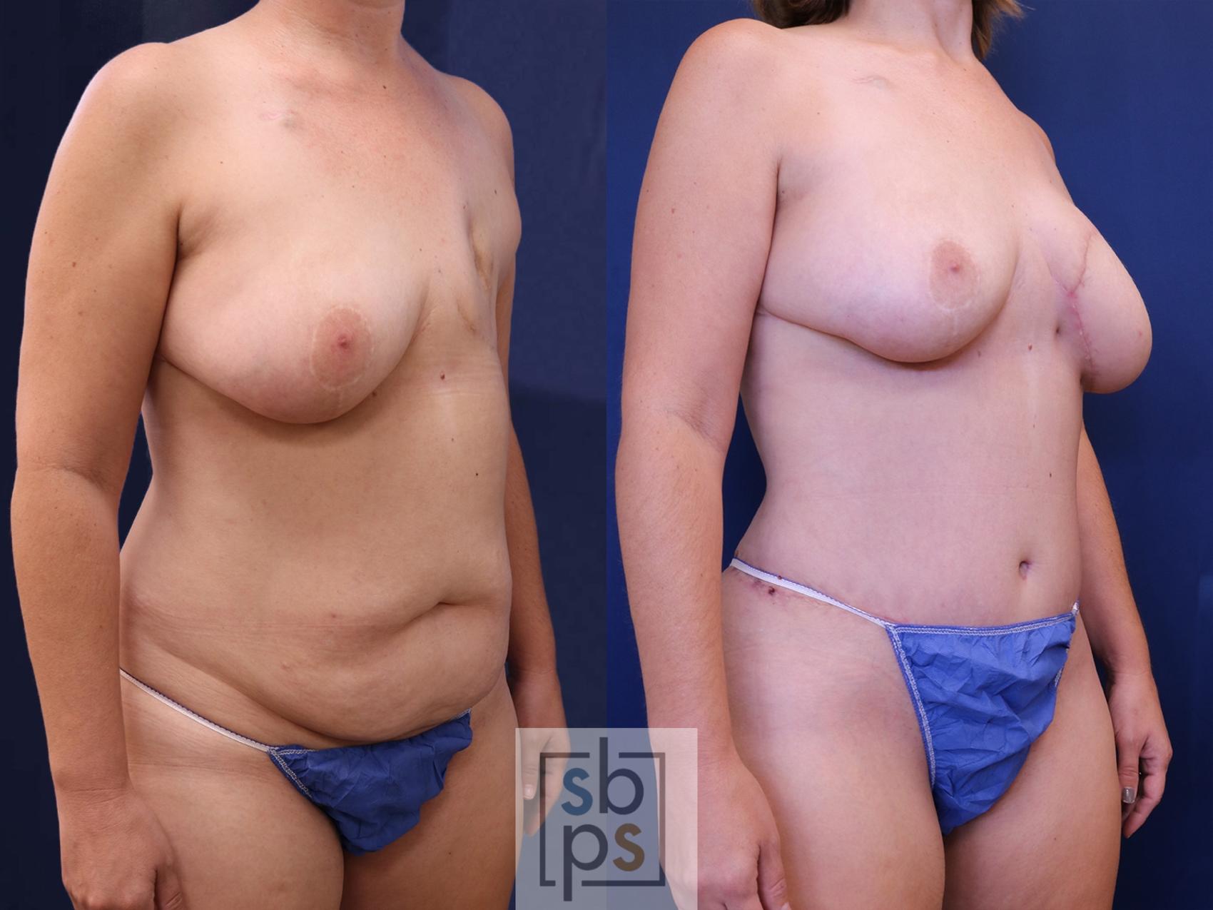 Before & After Breast Reconstruction Case 536 Right Oblique View in Los Angeles, Torrance & Long Beach, CA