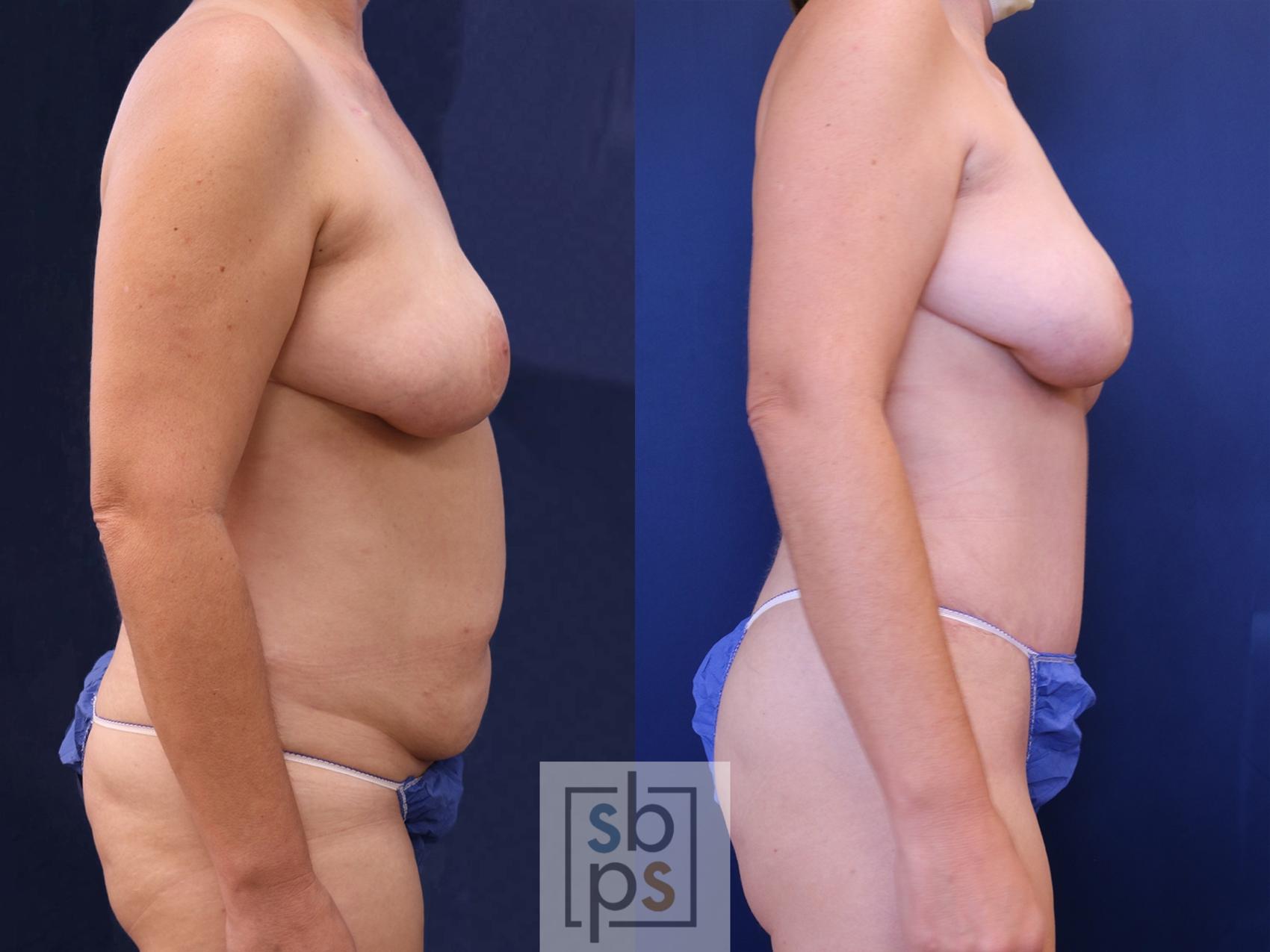 Before & After Breast Reconstruction Case 536 Right Side View in Los Angeles, Torrance & Long Beach, CA
