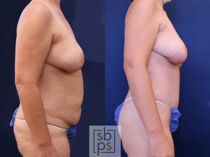 Before & After Breast Reconstruction Case 536 Right Side View in Torrance, CA