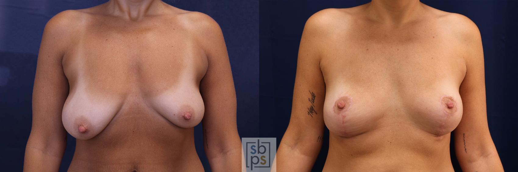Before & After Breast Reduction Case 578 Front View in Torrance, CA