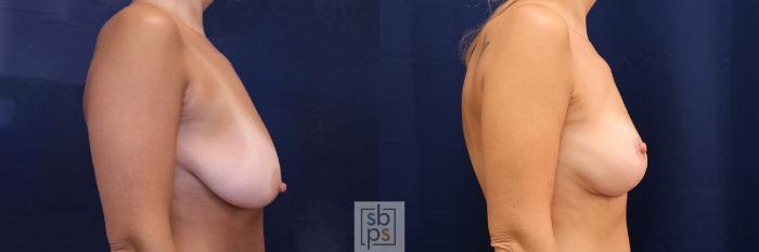 Before & After Breast Lift Case 578 Left Side View in Torrance, CA