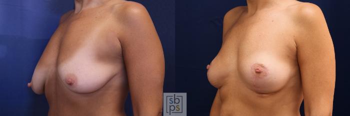 Before & After Breast Lift Case 578 Right Oblique View in Torrance, CA