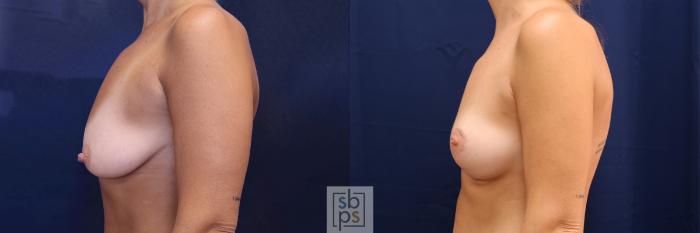 Before & After Breast Lift Case 578 Right Side View in Torrance, CA