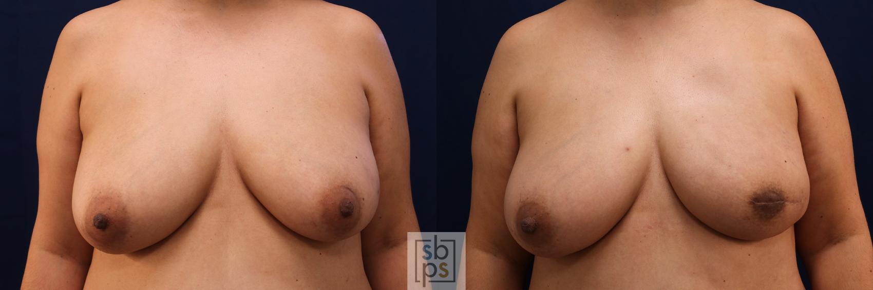 Before & After Breast Reconstruction Case 587 Front View in Torrance, CA